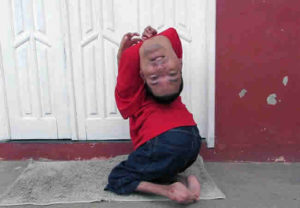 Arthrogryposis Multiplex Congenita: An Upside Down Head